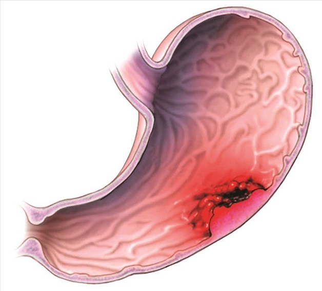 Viêm Dạ Dày Mãn Tính